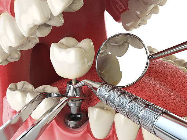 Best Emergency Wisdom Teeth Removal in Macon, MS